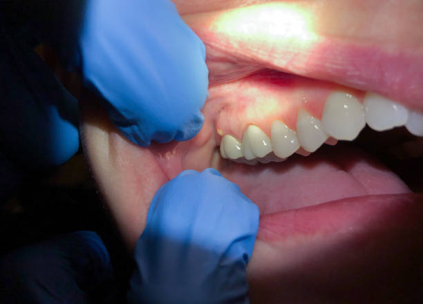 Best Emergency Root Canal Treatment in Ashford, AL